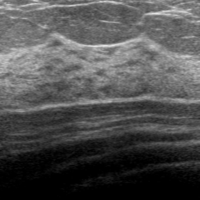 Ultrasound breast – unprocessed