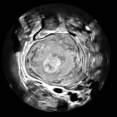 ContextVision Ultrasound Breast processed with Rivent 3D