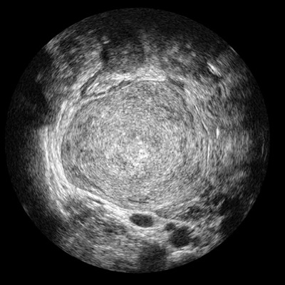 ContextVision Ultrasound Rivent Breast not processed